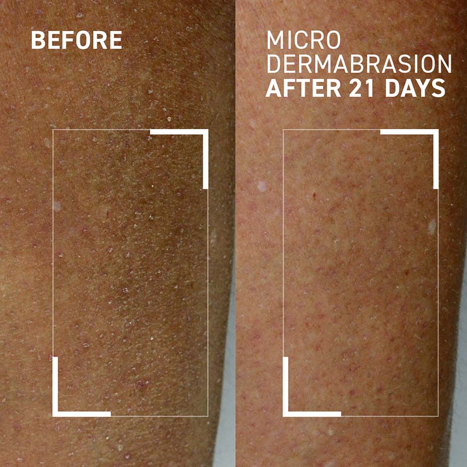 Microdermabrasion Body Exfoliator