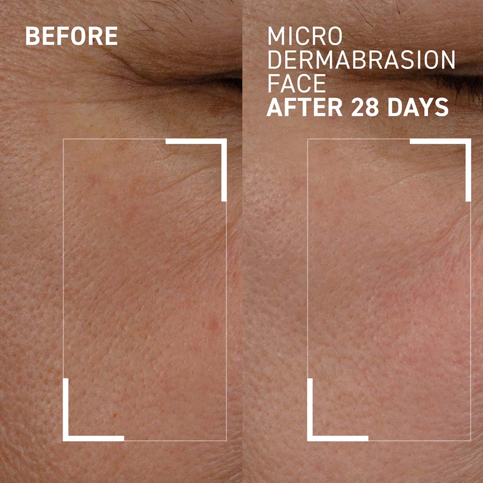 Microdermabrasion Face Exfoliator